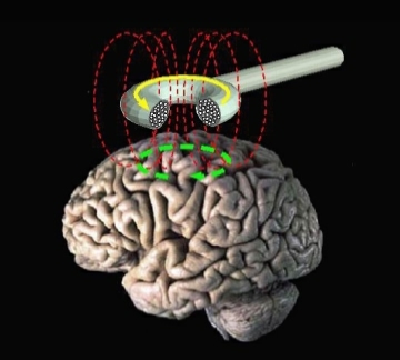 Transcranial magnetic stimulation by Eric Wassermann, M.D. Public domain via Wikimedia Commons.