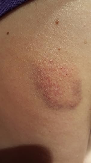 Day 3...still looks gnarly