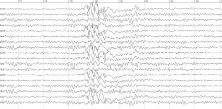 bipolar+montage+eeg+only+spike+and+wave_resized