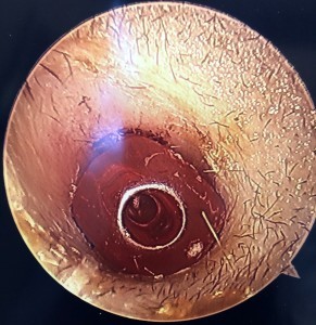 This is a bead as it sat in the child's ear canal