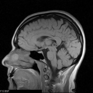 mri scan