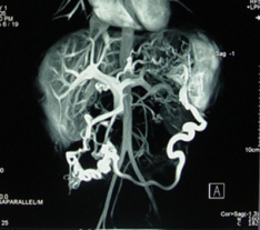 portal venous system showing splenic vein thrombosis