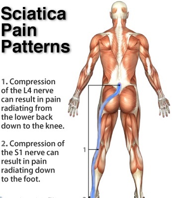 Old-Home-Remedies-for-Sciatica-Treatment-and-Sciatic-Nerve-Pain-Relief-111