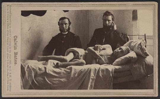 Calvin Bates served in Company E of the 20th Maine. Like Tommy he was captured at The Wilderness and ended up in Andersonville. He survived, but his ordeal there led ultimately to the amputation of both of his feet (Library of Congress)