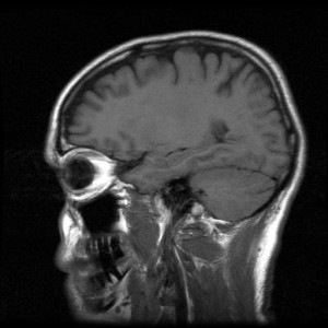 tumor