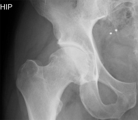 hip xray