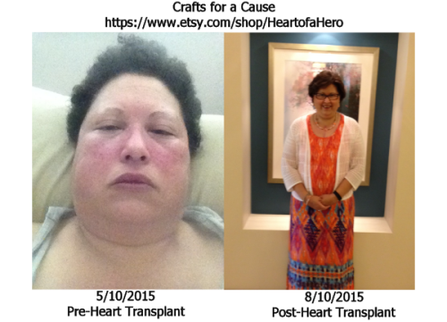 Karen_Transplant-before-after