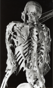 Skeleton of Harry Eastlack at the Mutter Museum. Courtesy: © A.B. Shafritz et al., New Eng. J. Med., 335 (8): 555-61, 1996, Source: http://www.uphs.upenn.edu/news/news_releases/apr06/briefing210406.htm 