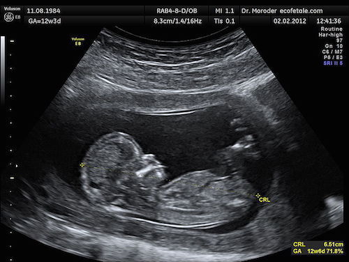 CRL_Crown_rump_lengh_12_weeks_ecografia_Dr._Wolfgang_Moroder.jpg