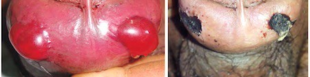 NEJM-snakebite