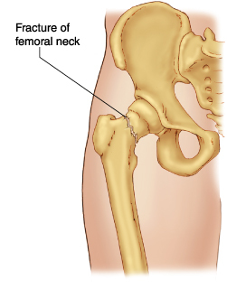 femoralneck