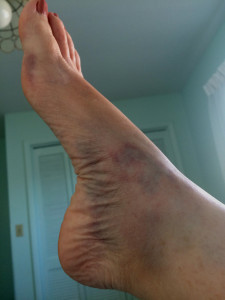 Right Foot next day
