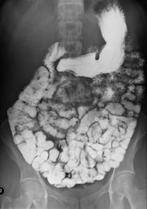 Small_bowel_Barium_jeffrey_dach_MD