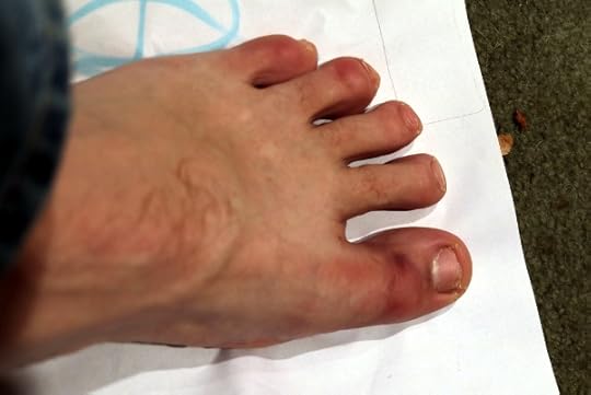 My capture-the-flag injury.