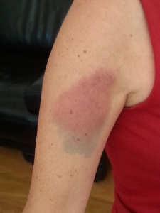 It's fairly impressive this bruise!