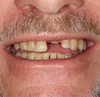 Image result for US missing teeth