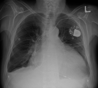 pacemaker x-ray