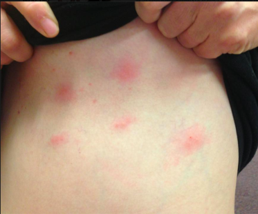 Kristen with Shingles…and YES I still wrote.