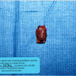 Parathyroid Tumor