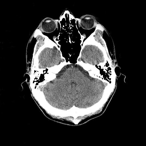 Image CreditL CT scan of a normal human brain by Andrew Ciscel. CC BY-SA 2.0 via Wikimedia Commons.