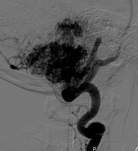 ER scans of AVM on April 21, 2008