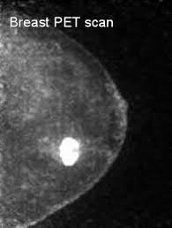 breast cancer jeffrey dach md