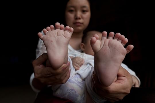 polydactylism