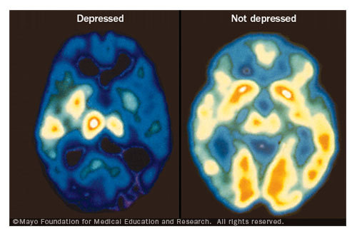 depression_s1_mayo