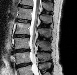 Spine MRI image