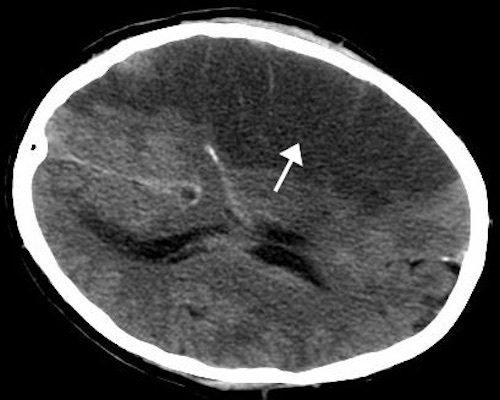 327px-MCA_Territory_Infarct.jpg