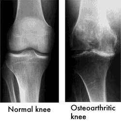 osteoarthritis knee