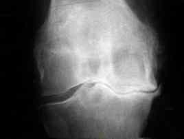 osteoarthritis knee