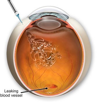 Injection of enzymes into he eyeball to inhibit the leaking behind the retina. Not a lot of fun.