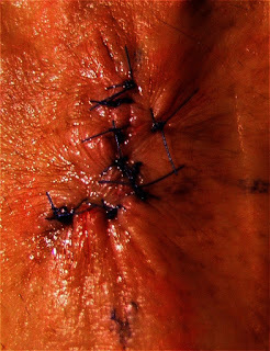 Stitches