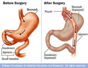 bariatric-surgery