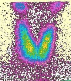 ThyroidRadionuclideScanThyroxine