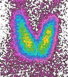 Technesium-99M-Radionuclide-Scan-of-Thyroid-Gland