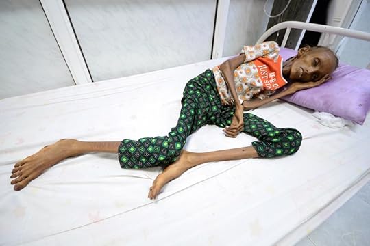 Saida Ahmad Baghili, 18, lies on a bed at the al-Thawra hospital where she receives treatment for severe acute malnutrition in the Red Sea port city of Houdieda, Yemen