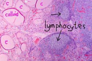 Hashimoto's_thyroiditis,_HE_5_Z_reduced