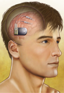 neuropace