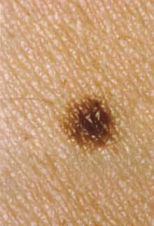 common-mole