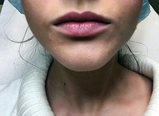 merilin-taimre-facetox-detox-tervis-nahk-akne-ilu-mask-nägu-punnid-viljakusmonitor-daysy-menstruatsioon-antibeebipillid-keemiline-koorimine-medemis-clinic-hape-paljas-porgand-merilin-taimre-tervis-blogi