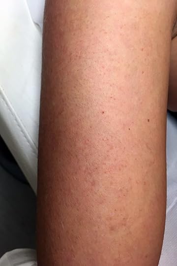 merilin-taimre-facetox-detox-tervis-nahk-akne-ilu-mask-nägu-punnid-viljakusmonitor-daysy-menstruatsioon-antibeebipillid-keemiline-koorimine-medemis-clinic-hape-paljas-porgand-merilin-taimre-tervis-blogi