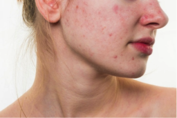 acne