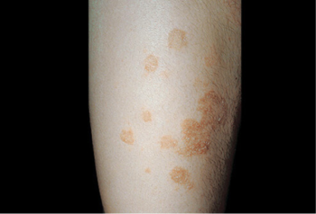 eczema