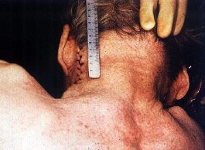 autopsy