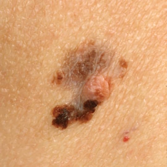 Melanoma