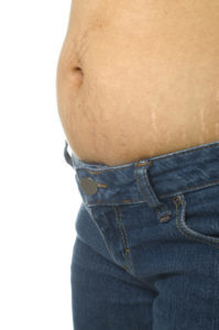 Stretch mark on mature woman stomach wearing blue jeans