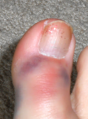 Image result for broken big toe