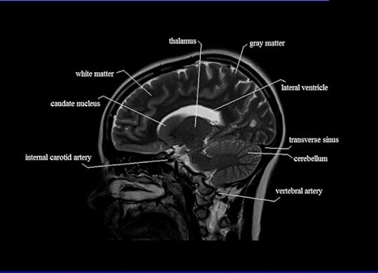 Image result for mri of the brain